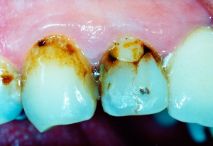 unslightly teeth