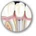 Bridge Dental Smiles treatments - Implants