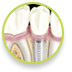Bridge Dental Treatments - Implants