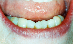 discoloured teeth after treatment