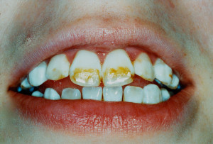 unsightly teeth enamel